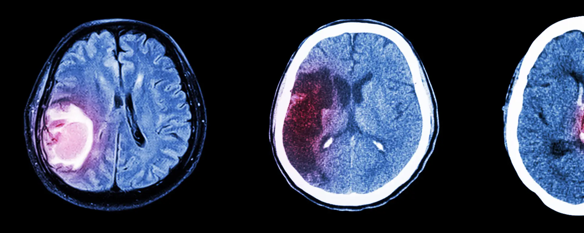 Brain CT scan of injuries