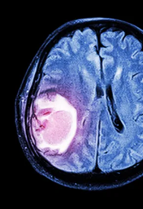 Brain injury CT scan